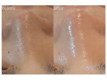 シャリル(charire)/毛穴詰まり解消♪