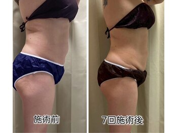クールスパ(COOL SPA)/ &nbsp;【40代女性】お腹-6.5cm