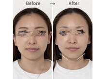 ジェイミープラス 表参道(J‘aimee +)/小顔・リフトアップの施術変化