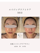 サロンドコーデ(salon de co-de)/エイジングリフトケア