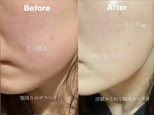 ヨソイ(yosoy)/ハーブピーリング