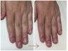 【男性/深爪矯正】モニター価格☆見た目改善で清潔感のある指先へ　￥31900→