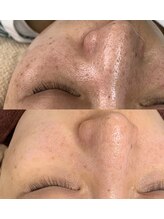 サロン リュンヌ(salon lune)/プラズマ、光フェイシャル