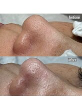 ライカブルー(RaicA BluE)/施術写真　before-after