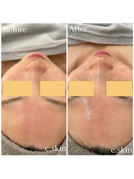 シースキン 盛岡駅前店(c.skin)/お客様ビフォーアフター♪