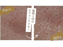 ソニョ(Sonyo)の雰囲気（施術1回　毛穴とキメの変化　頑固な毛穴汚れがとれキメもUP）