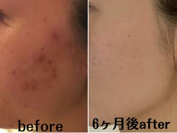 ベレミアム(Bellemium)/ニキビケア