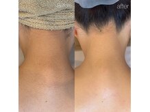 WAX脱毛で垢抜け後ろ姿に◎ブライダルもご相談ください♪♪