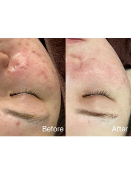 美白ケアをしたい