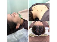 ふれあい整骨院の雰囲気（鍼灸・美容鍼・頭皮鍼になります。鍼施術はリピート率No.1です）