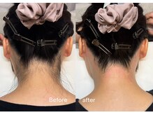 エルピス(ELPIS)/うなじ Wax脱毛