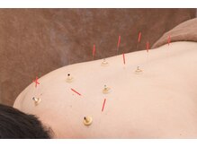 五反野鍼灸整骨院/「6」鍼灸施術で自律神経調整