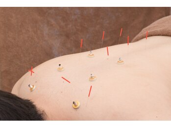 五反野鍼灸整骨院/「6」鍼灸施術で自律神経調整