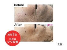 トリアングル(TLIENGLE)/最新ポレーションビフォアフ