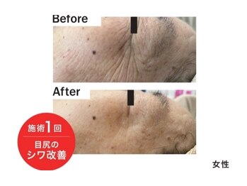 トリアングル(TLIENGLE)/最新ポレーションビフォアフ