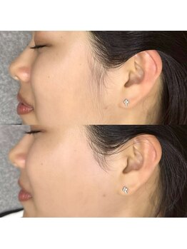 ラズリ(LAZULI)の写真/お顔ワックス脱毛でツヤ肌GET♪お顔の産毛、角質をケアしてお化粧ノリ抜群に☆トーンUPで明るい素肌印象◎