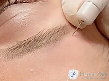 プラチナワックス(Platine Wax)/ブレンド脱毛（美容電気脱毛）