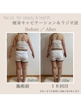 ルシアル(Rucial)/痩身◇ビフォー／アフター