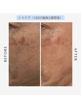 ジール(GIILL)/男性シミケアビフォーアフター