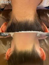 ラナ(Lana)/うなじW脱毛