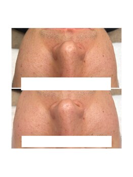 ホワイトワックス 京都四条烏丸(WHITE WAX)/《全顔》フェイシャルワックス