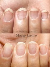 マリーロール 淀屋橋本店(Marie Laure)/自爪育成/深爪矯正/ネイルケア