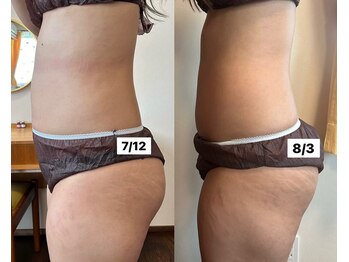 サロン サルー(SALON Salud)/◇韓国式痩身