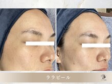 キレイ美肌 北心斎橋店/ララピール