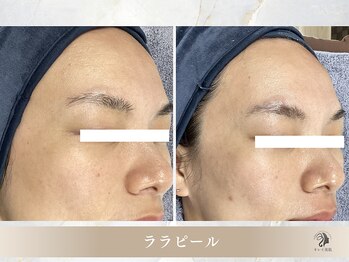 キレイ美肌 北心斎橋店/ララピール