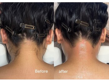 エルピス(ELPIS)/うなじ脱毛