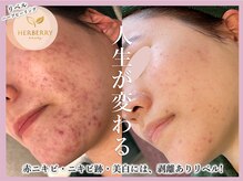 ハーバリー 天王寺(HERBERRY)/ハーブピーリング専門店HERBERRY