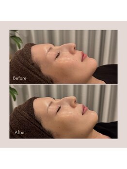 アウラ 砺波店(AULA)の写真/【韓国美肌を日本で実感】水光肌ララピール☆毛穴引き締めや皮脂抑制でニキビ予防にも◎