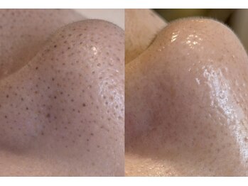 メイヴィ 四日市(Maivi)の写真/【4/15(水)~ スタート！】諦めていた毛穴の黒ずみに！"トルネード式毛穴洗浄"で毛穴の奥までしっかり洗浄◎