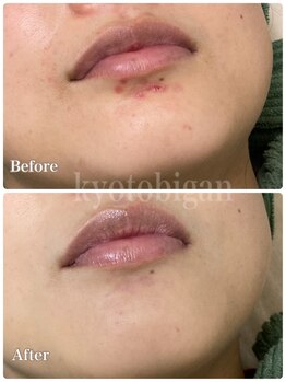 京都美顔/あご・口まわりのニキビケア