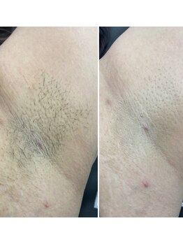 ヴィテラス バイ アリア(Veteras by aria)/☆実感出来る脱毛☆