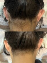 マナ(mana)/うなじ脱毛