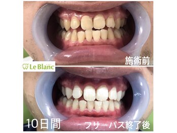 ルブラン 奈良店(Le Blanc)/自分史上最高の白い歯を!