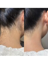 スイ 四条烏丸(SUI)/〇うなじ脱毛