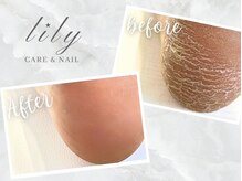 角質ケアでしっとり健康的なかかとに♪