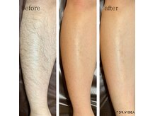 SIMBAが提供するクリアスキン脱毛の効果です!!