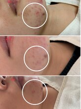 サロンドットブレスドットケイ(salon.bless.k)/繰り返す大人ニキビ