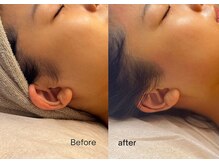 エルピス(ELPIS)/もみあげ Wax脱毛