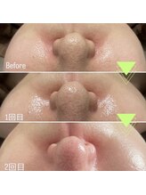 コア(Coeur)/【艶肌爆誕】lamination peeling