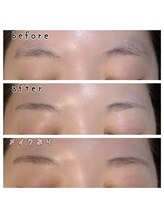 リノエ(lin'oe)/顔脱毛・眉周り脱毛♪