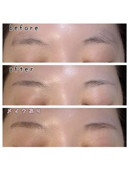 リノエ(lin'oe)/顔脱毛・眉周り脱毛♪