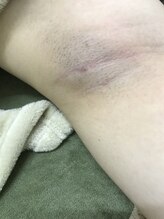 ナノハナ/鹿沼市の全身脱毛美容室ナノハナ