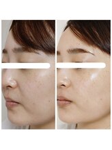 アンティクイーン(Antiqueen)/毛穴引き締め、ほうれい線レス