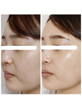 アンティクイーン(Antiqueen)/毛穴引き締め、ほうれい線レス