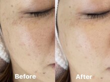 ヨソイ(yosoy)/ハーブピーリング