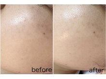 毛穴塾/【韓国最新美容】ララピール